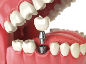 best dental implants doha